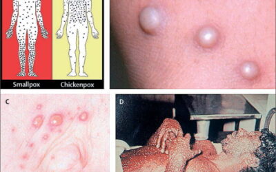 Smallpox is it the future of bioweapons ? Mass vaccination importance in stopping its effects.