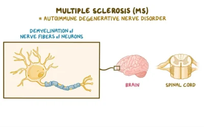 Multiple Sclerosis: Understanding the Causes, Symptoms, and Latest Treatment Options