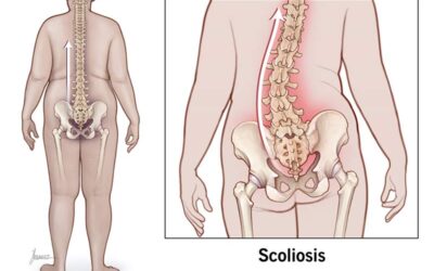 Scoliosis: Understanding the Causes, Diagnosis, and Treatment for Spinal Health