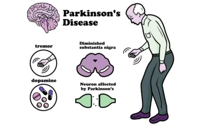 Parkinson’s Disease: Unraveling the Causes, Symptoms, and Advances in Treatment