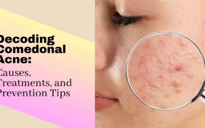 Acne and Its Impact on Skin Health: Effective Treatment Methods and Prevention Tips.