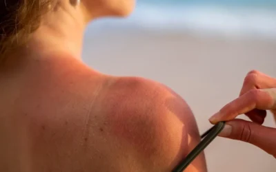 Examining Skin Cancer Risk Perceptions and Reported Sunburns Among U.S. Adults.