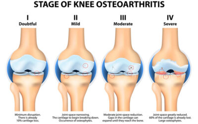 Earlier ACL Surgery May Reduce Risk of Knee Osteoarthritis.