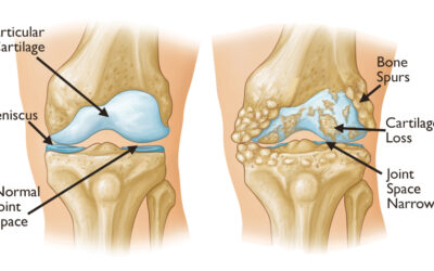 Osteoarthritis: Causes, Symptoms, and the Latest Treatment Options for Joint Health