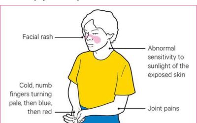 Lupus: Exploring the Symptoms, Diagnosis, and Treatment Options for This Complex Autoimmune Disease.